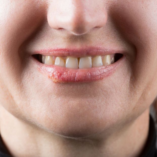 Aprende a prevenir el herpes labial, muy común en verano