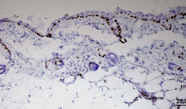 Descubren una de las estrategias del cáncer para escapar de la quimioterapia