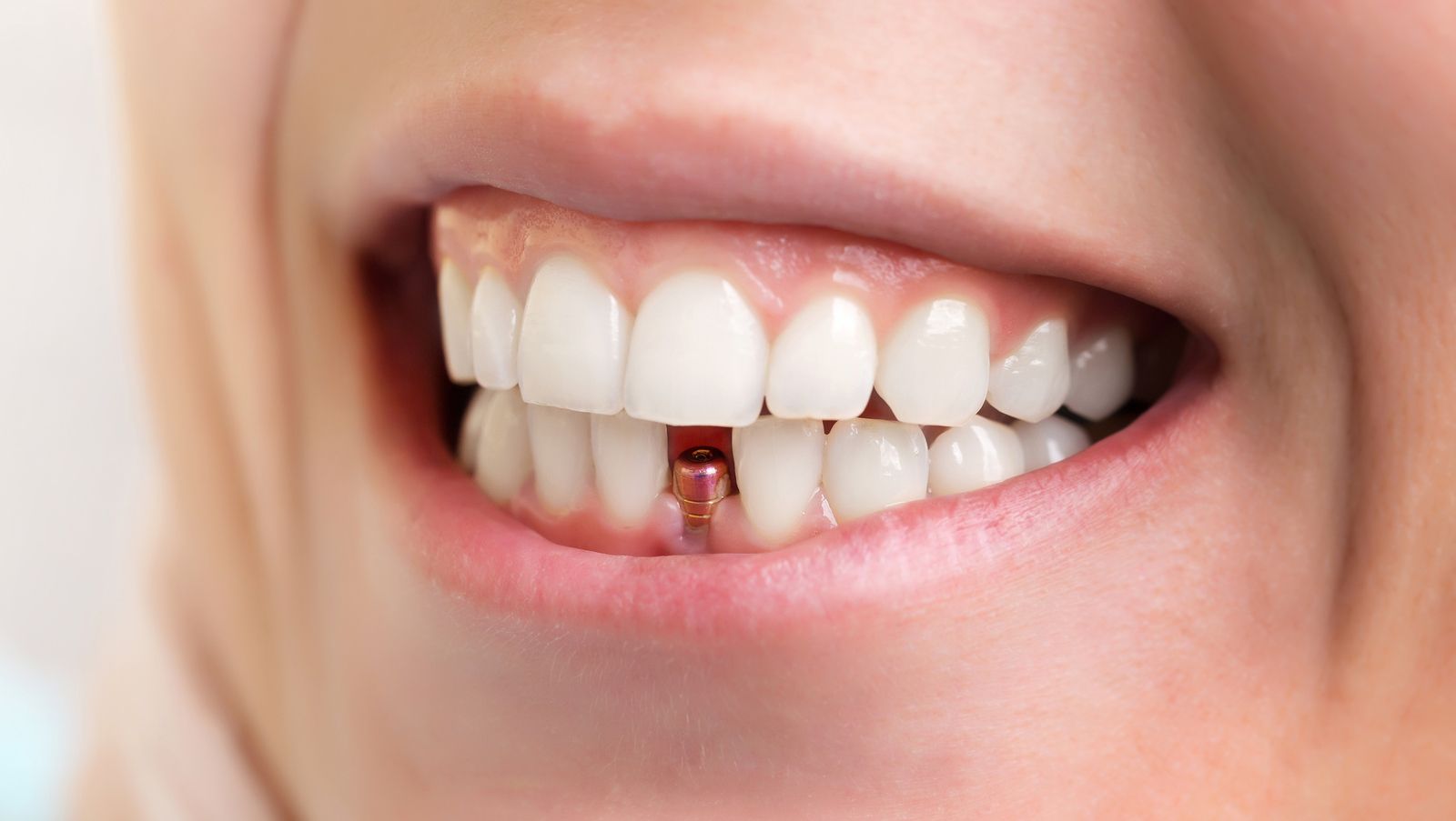 Falta de piezas dentales. Qué es la periimplantitis y cómo afecta a tus implantes dentales