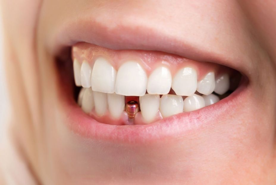 Falta de piezas dentales. Qué es la periimplantitis y cómo afecta a tus implantes dentales