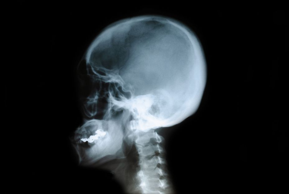 bigstock X ray Film Of The Head Child  429068828