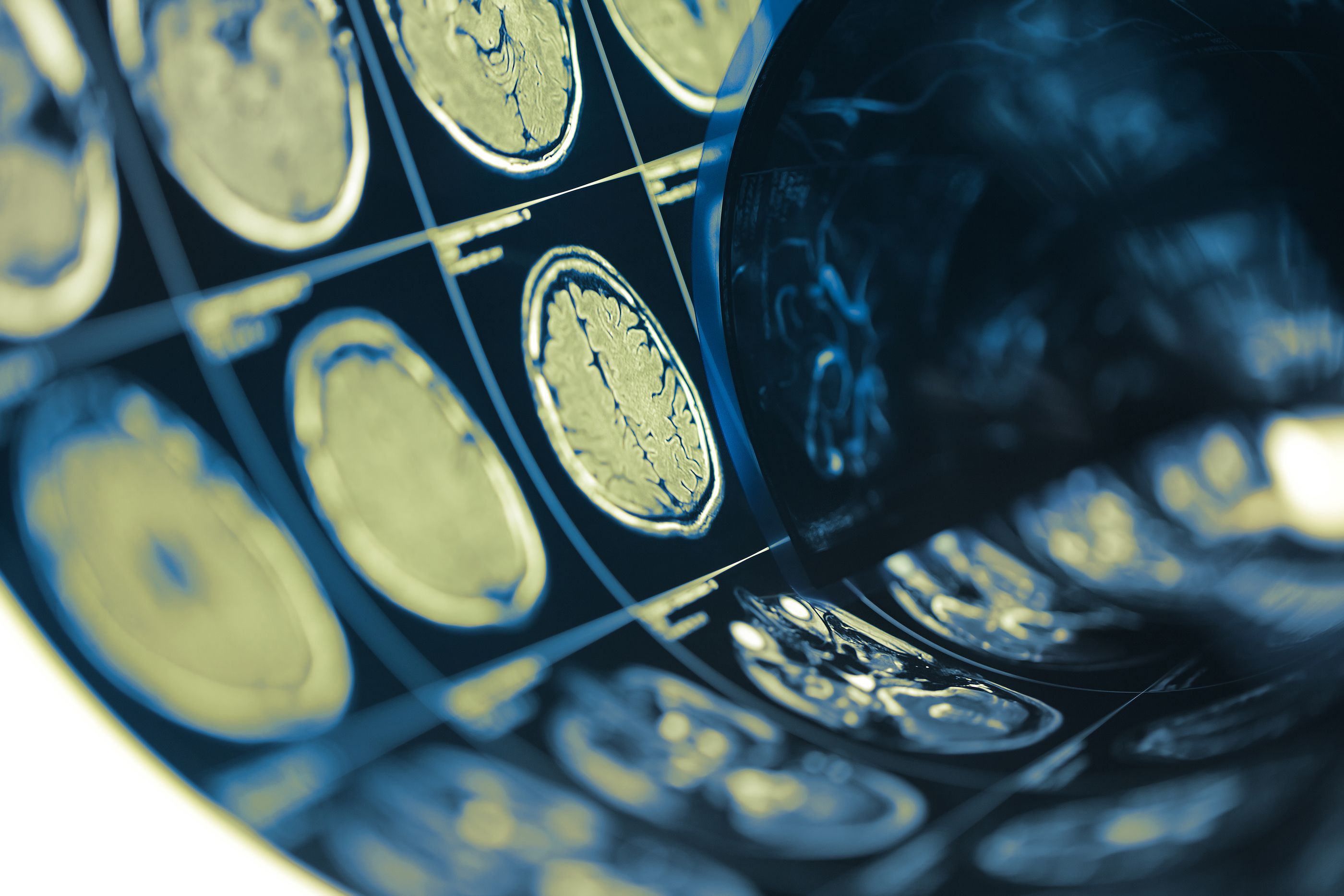 La inteligencia artificial logra predecir la genética de tumores cerebrales en menos de 90 segundos. Foto: Bigstock