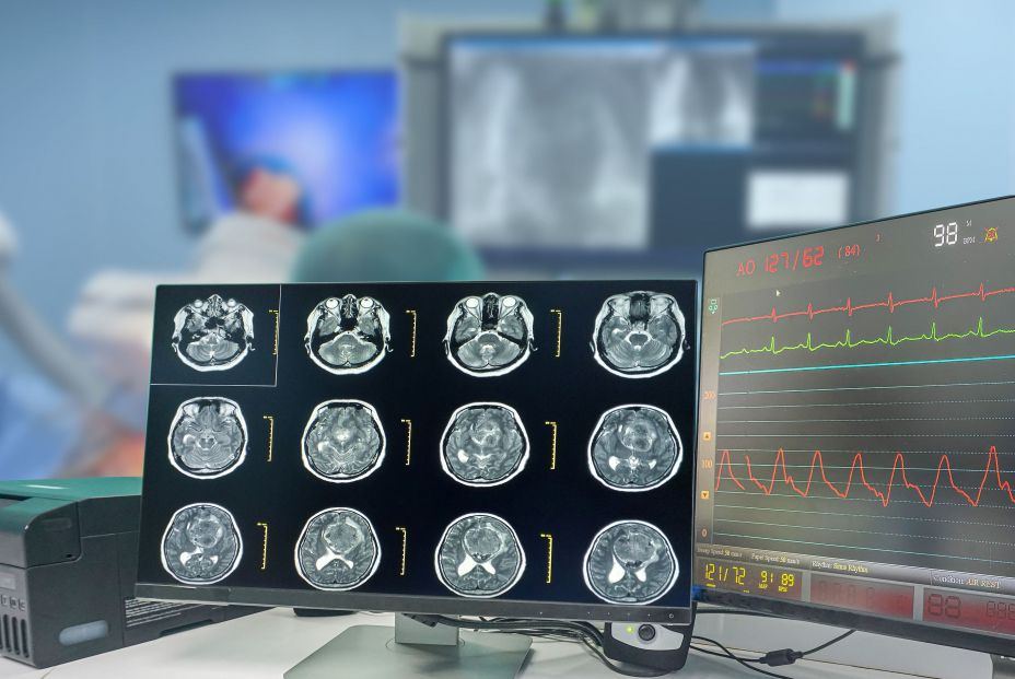 La inteligencia artificial logra predecir la genética de tumores cerebrales en menos de 90 segundos. Foto: Bigstock