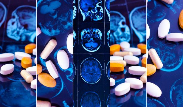 La nueva esperanza contra el alzhéimer es un fármaco 'silenciador de genes'