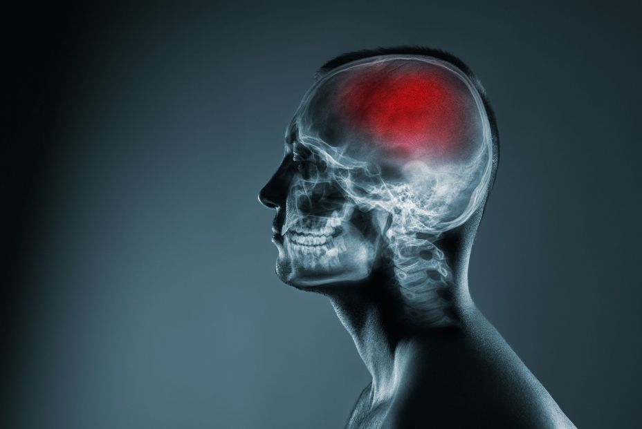 bigstock X ray Of A Mans Head Cerebral 402944414