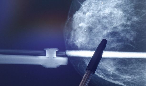 ¿Qué es una mama fibroquística? ¿Influye la edad de gestación en la aparición del cáncer de mama?