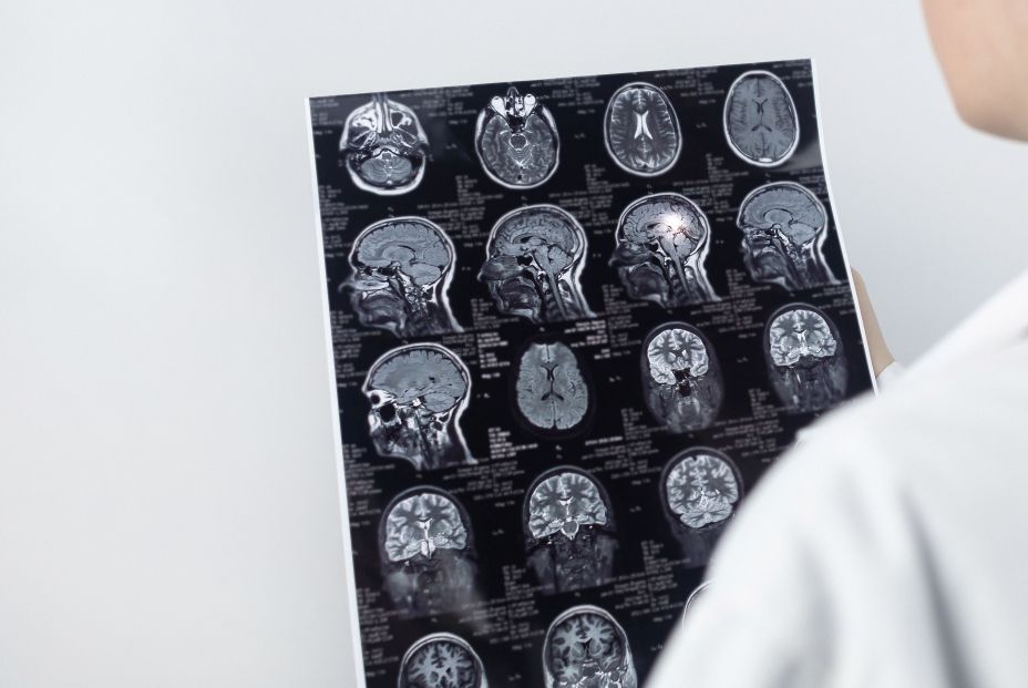 Cerebro de una persona con Alzheimer