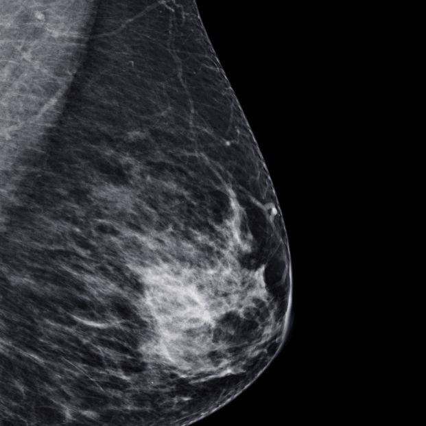 Los expertos apuestan por aumentar el cribado de cáncer de mama hasta los 74 años