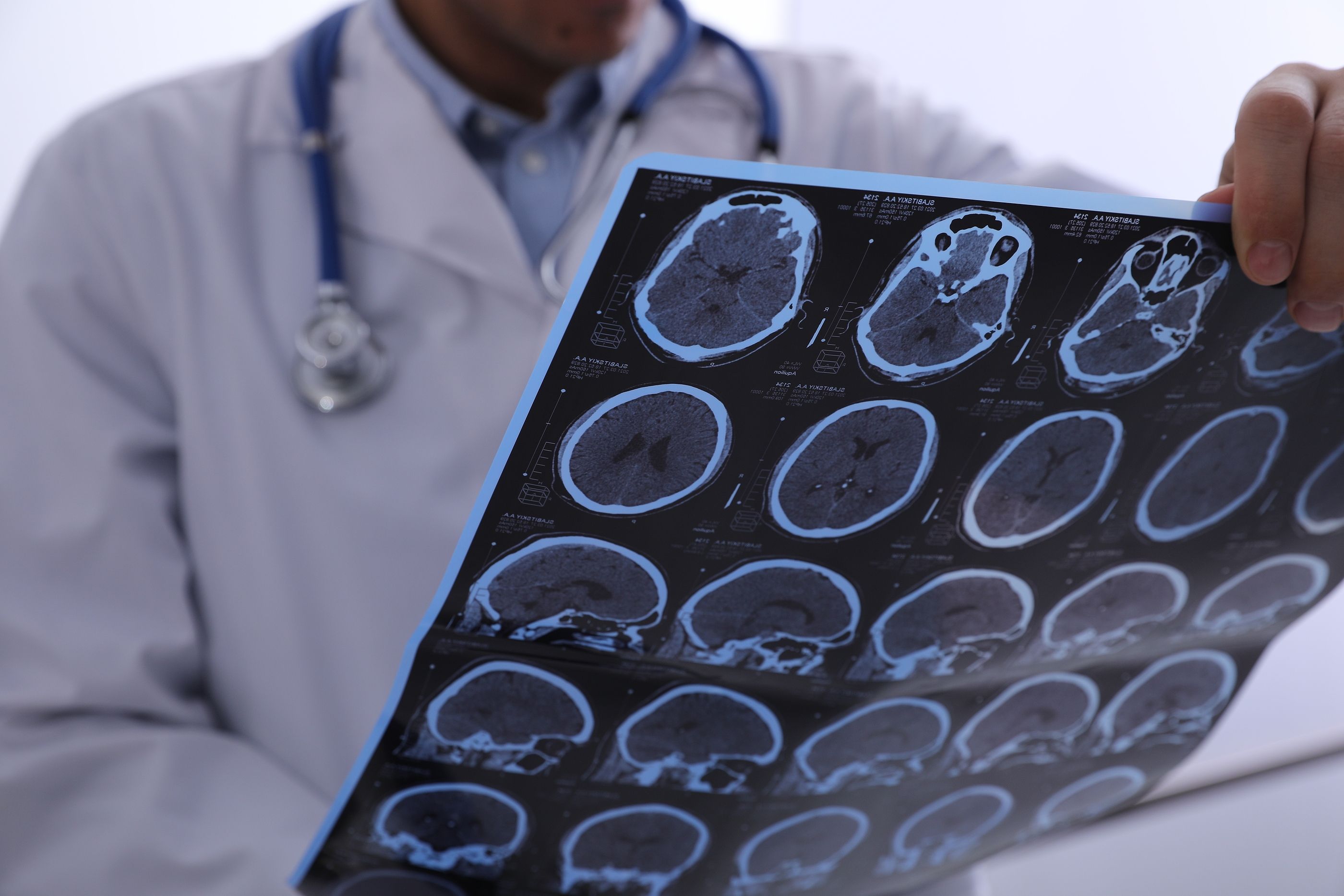 Un nuevo estudio abre la puerta a diferenciar mejor el alzhéimer de otras demencias