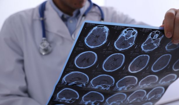 Un nuevo estudio abre la puerta a diferenciar mejor el alzhéimer de otras demencias