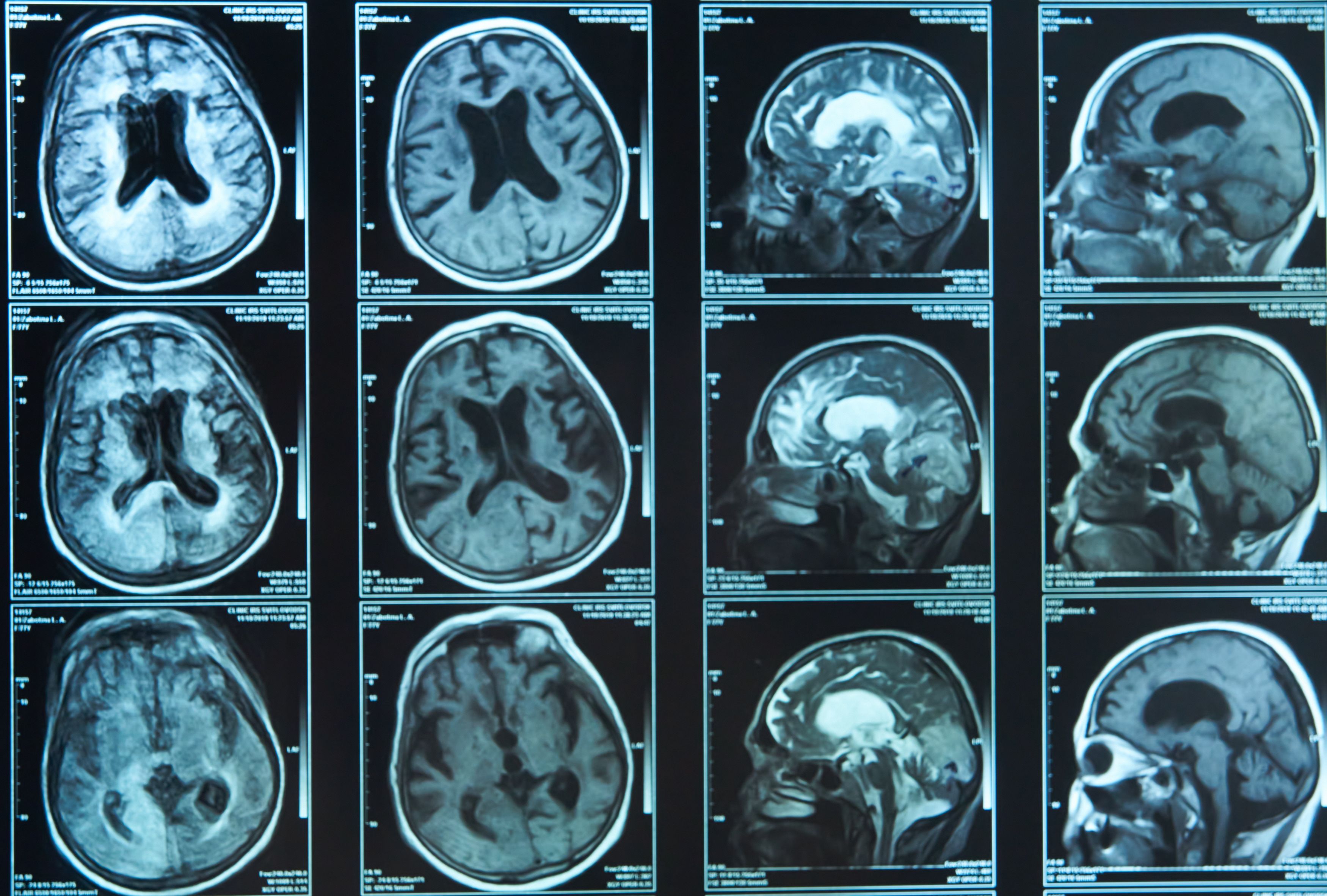 Un nuevo estudio ayuda a un mejor diagnósticos del Alzheimer con el uso de técnicas de imagen médica
