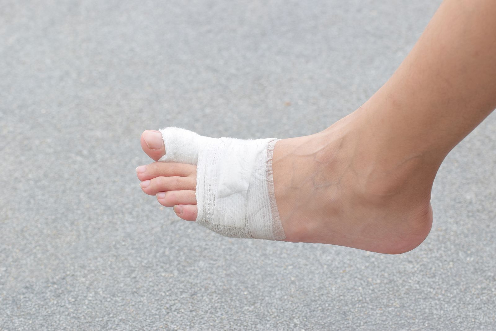 Cuidados antes una fractura de un dedo del pie