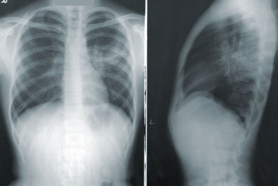 CSIC desarrolla un dispositivo en papel para el diagnóstico rápido de enfermedades pulmonares