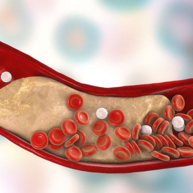 La acumulación de grasas y colesterol, el origen de la ateroesclerosis