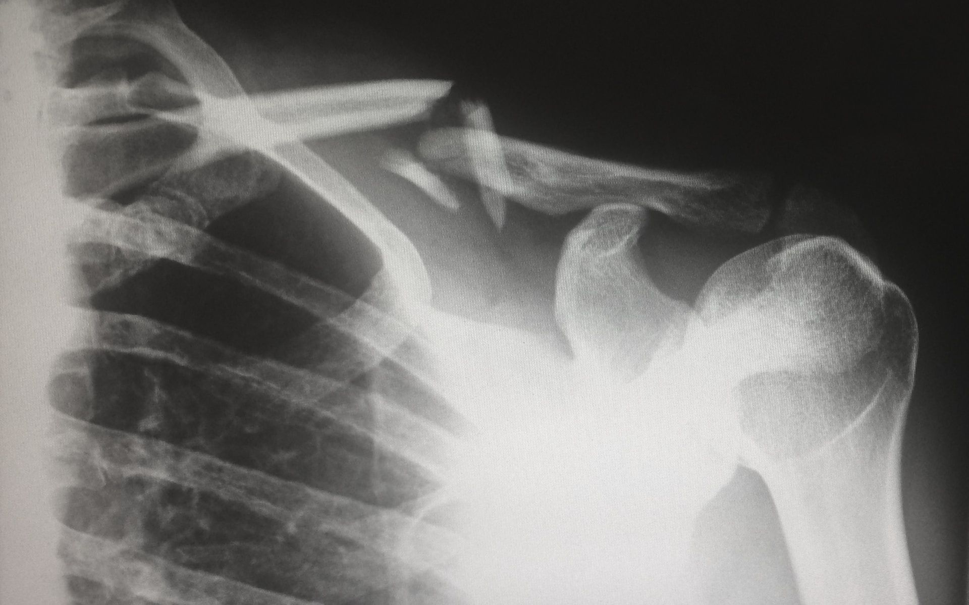 Avances: así son los nuevos tipos de implantes óseos creados para fortalecer los huesos dañados