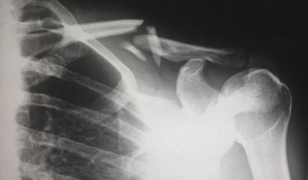Avances: así son los nuevos tipos de implantes óseos creados para fortalecer los huesos dañados