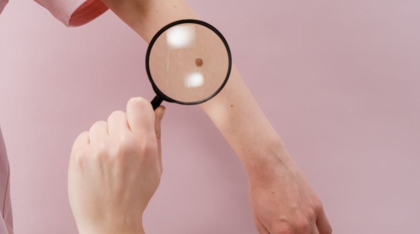 Golpe al melanoma: se podrá diagnosticar de forma temprana mediante biopsia líquida