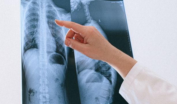 Identifican un gen que potencia la inmunoterapia en el cáncer de pulmón más agresivo al inhibirse