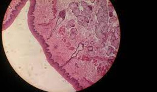 Desarrollan un nuevo método no invasivo para el diagnóstico de la esofagitis eosinofílica