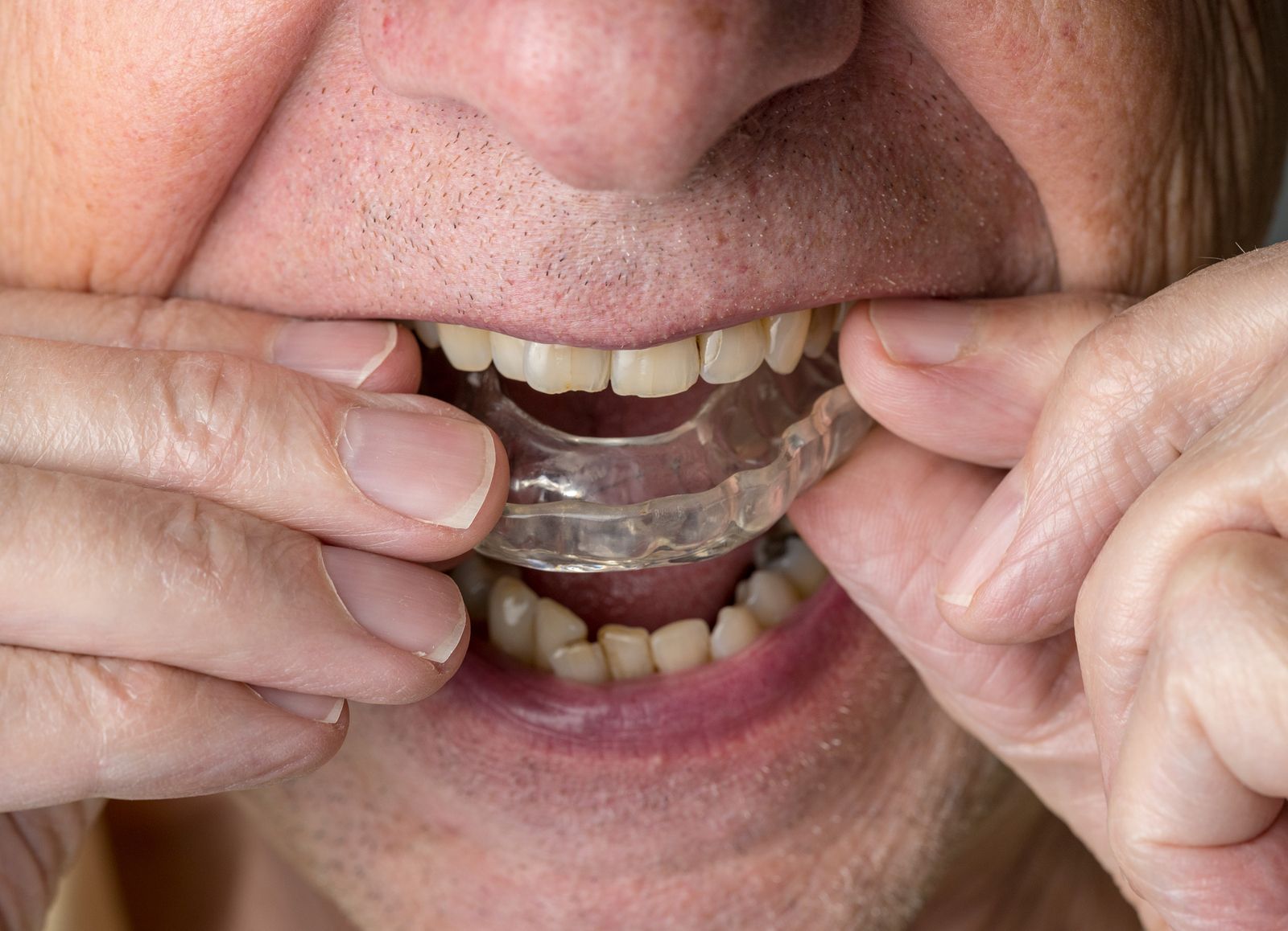 Te despejamos tus dudas sobre la ortodoncia invisible para personas mayores