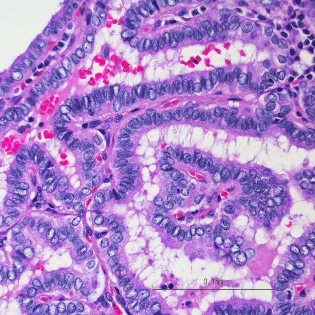 El uso de ecografías ha "revolucionado" el diagnóstico de cáncer de tiroides 