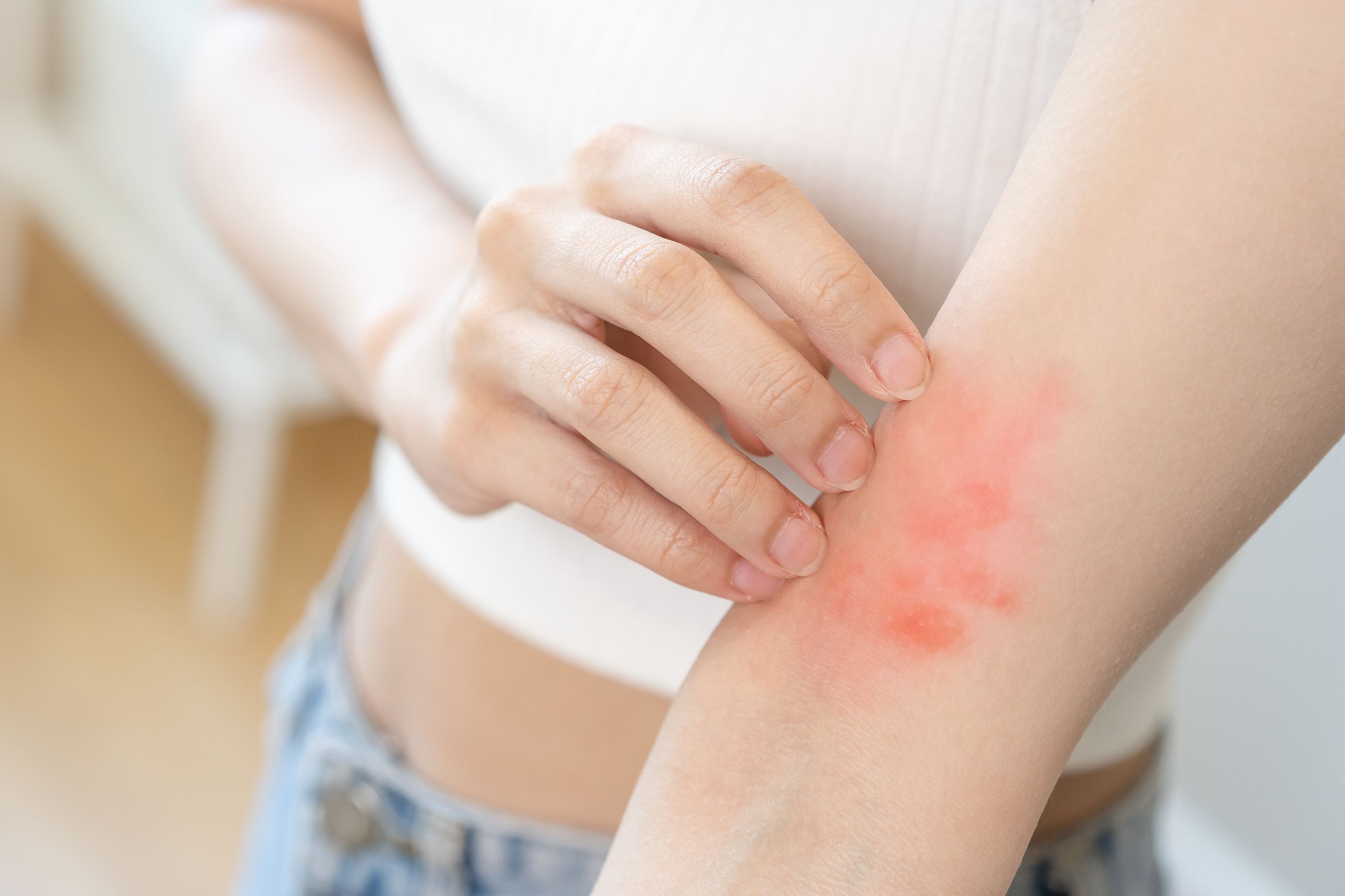 Consejos para evitar las picaduras de chinches, garrapatas y mosquitos. Foto: Bigstock