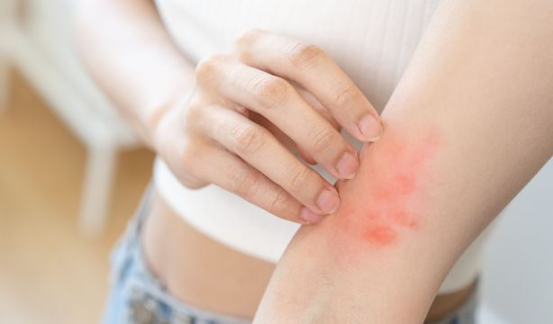 Consejos para evitar las picaduras de chinches, garrapatas y mosquitos. Foto: Bigstock