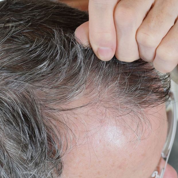 Tricotilomanía o arrancarse el pelo, qué hay detrás de este fenómeno