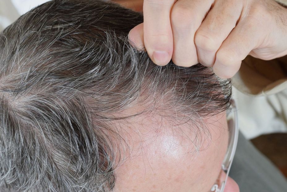 Tricotilomanía o arrancarse el pelo, qué hay detrás de este fenómeno