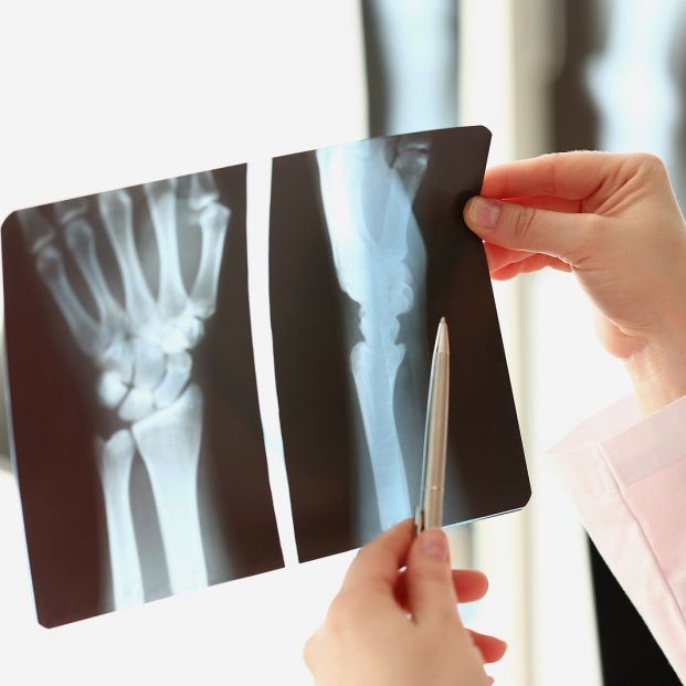 Investigan un tratamiento más eficaz para las personas que sufren artrosis dolorosa en la mano