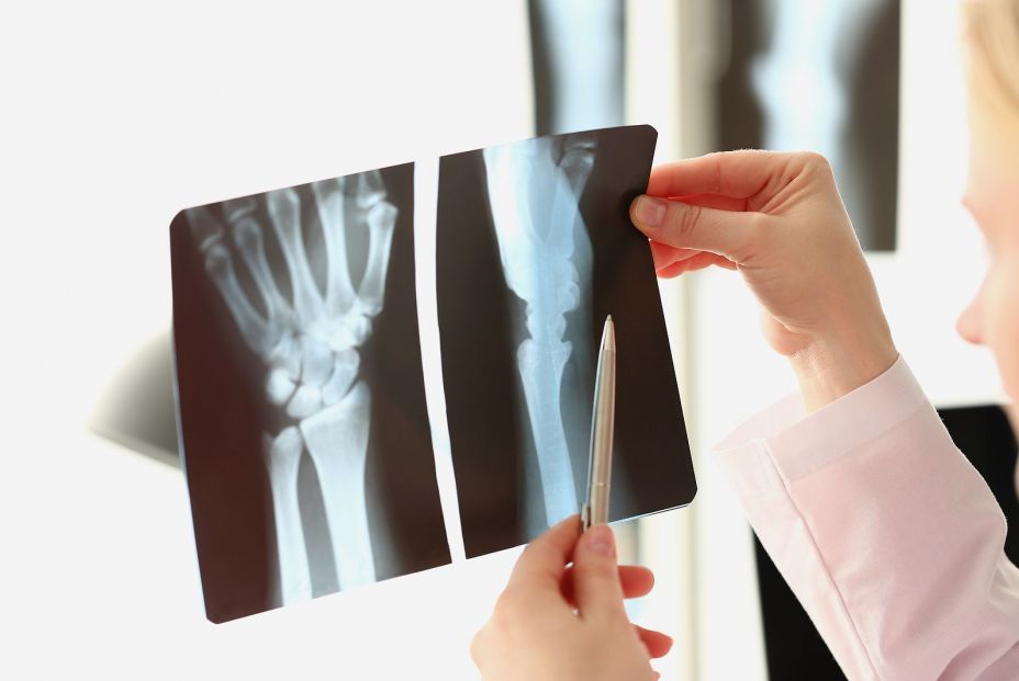Investigan un tratamiento más eficaz para las personas que sufren artrosis dolorosa en la mano