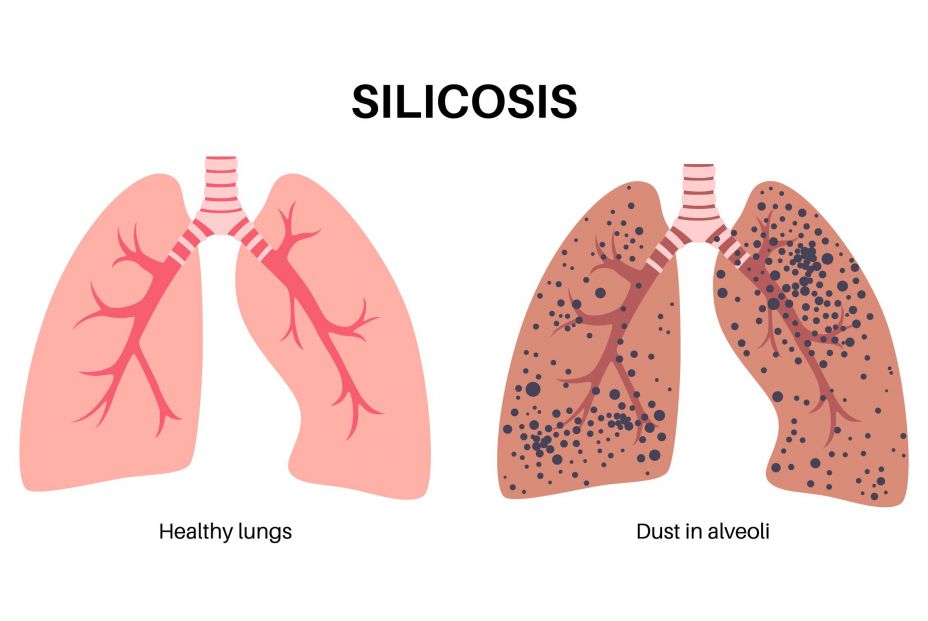 bigstock Silicosis Anatomical Poster L 475929455 bigstock Silicosis Anatomical Poster L 475929455