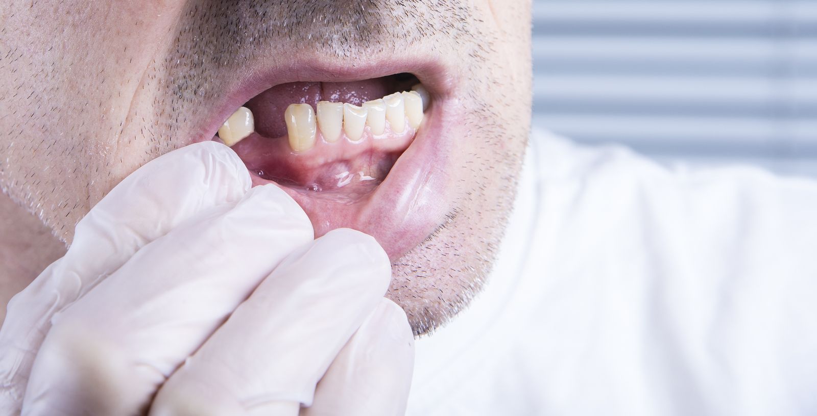 ¿Cómo afecta la falta de piezas dentales a tu salud y cómo remediarlo?