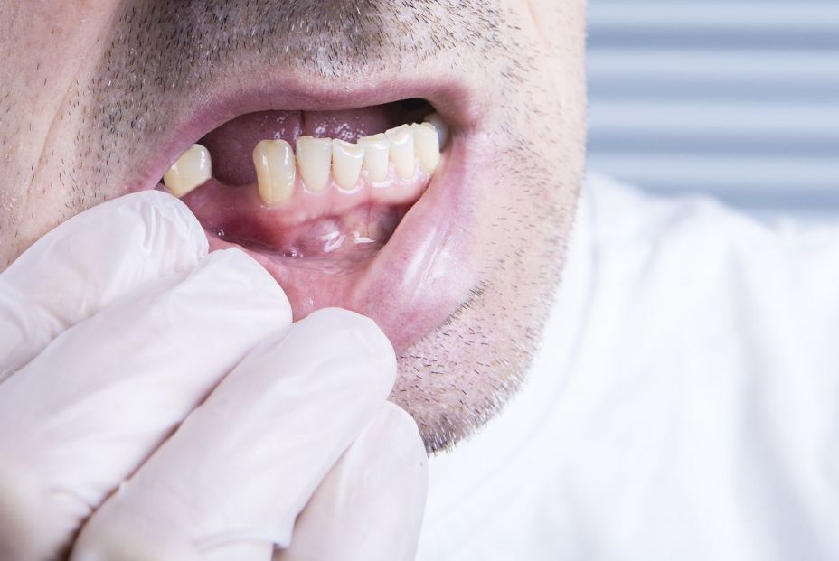 ¿Cómo afecta la falta de piezas dentales a tu salud y cómo remediarlo?