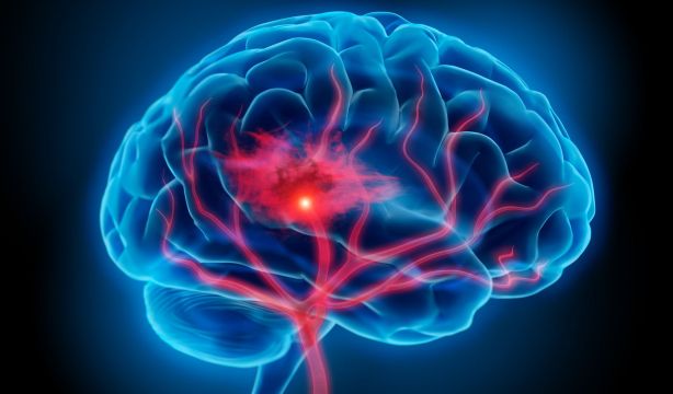 Nueva técnica monitoriza con precisión la evolución del daño en accidentes cerebrovasculares