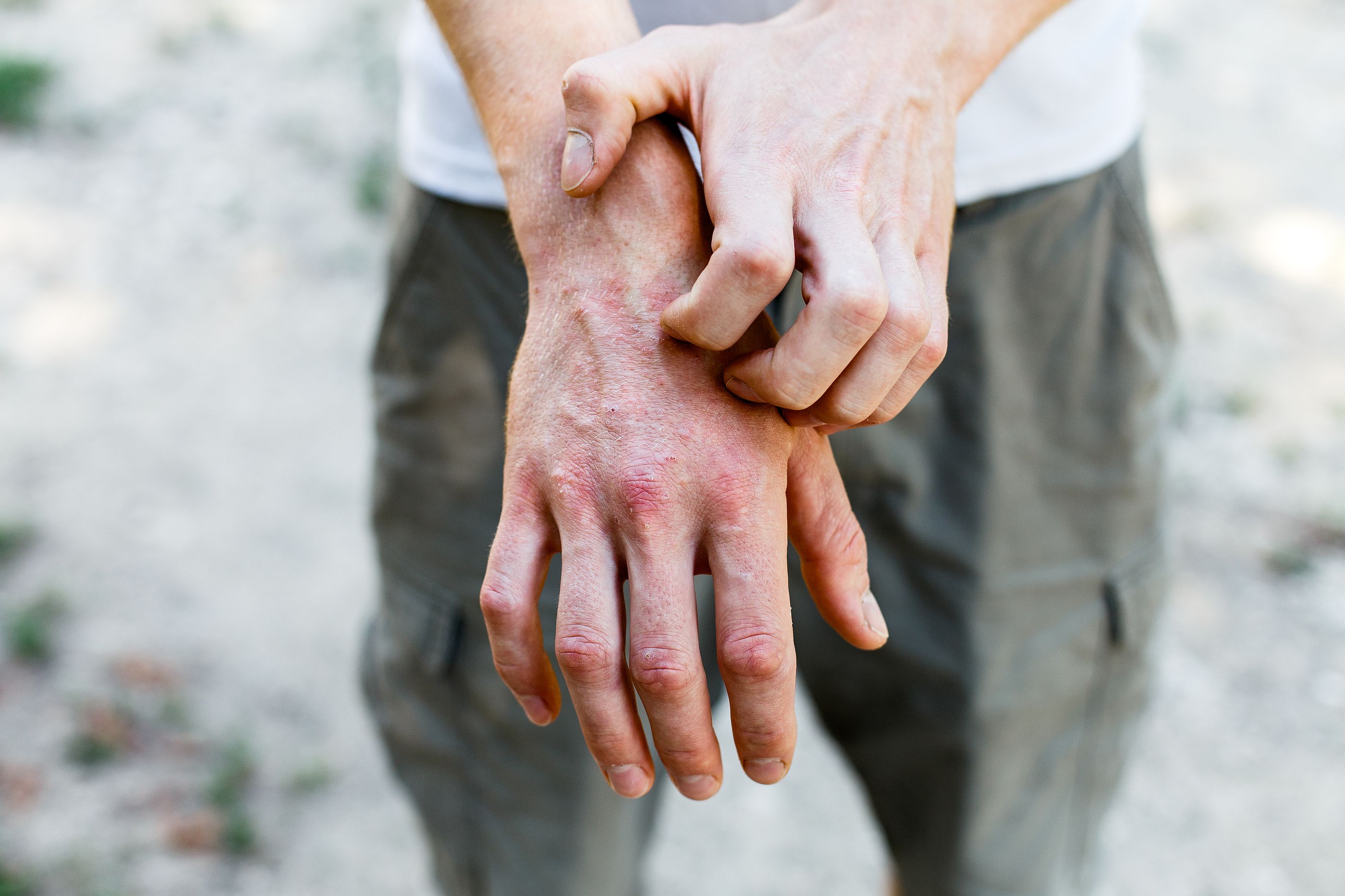 El uso excesivo de calefacción puede empeorar la dermatitis atópica (Bigstock)