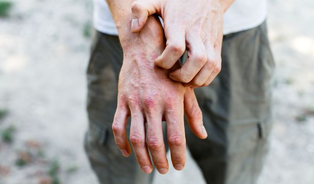 Consejos para proteger la piel en invierno: evita brotes de dermatitis y eccemas