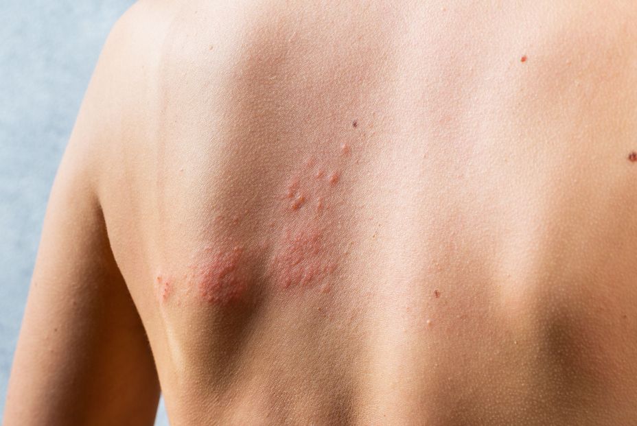 El exceso de calefacción podría afectar a tu dermatitis atópica (Bigstock)