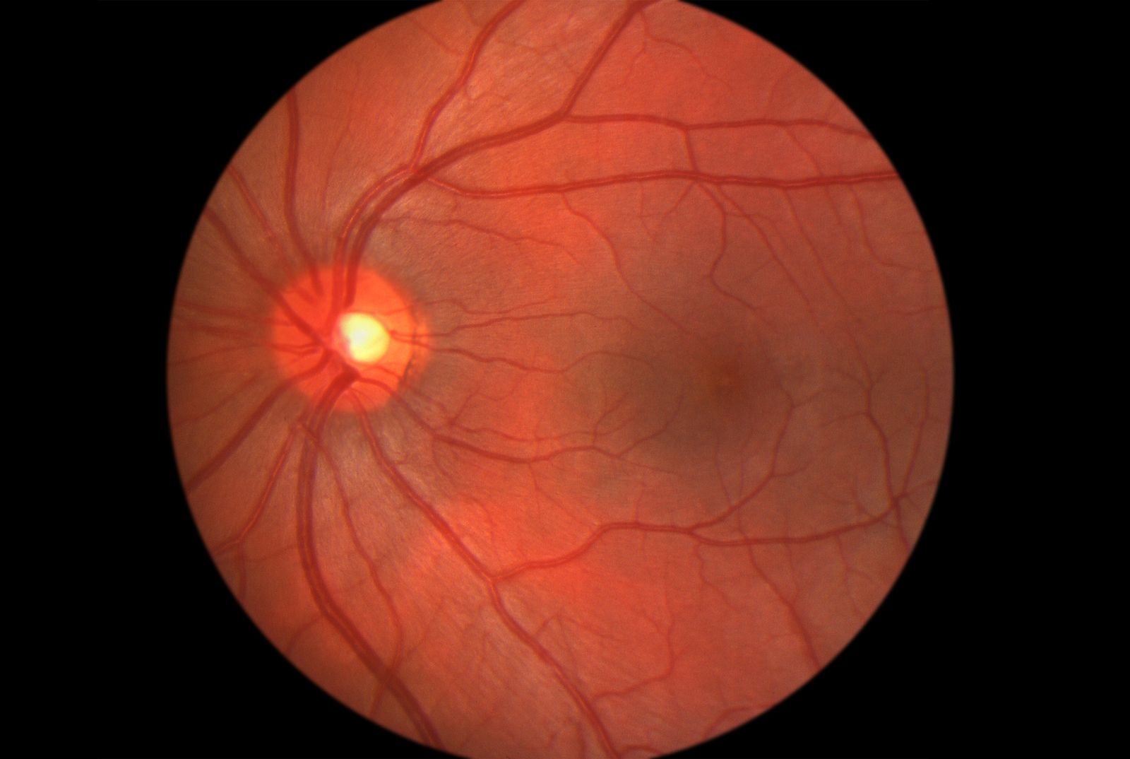 Nuevo avance en la curación de la pérdida de visión por diabetes