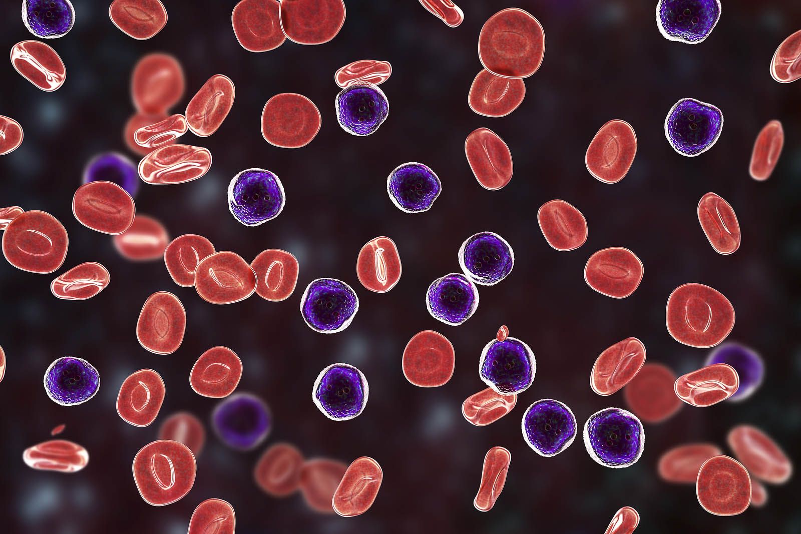 La leucemia promielocítica aguda tiene una tasa de curación del 80-90% gracias a los tratamientos dirigidos