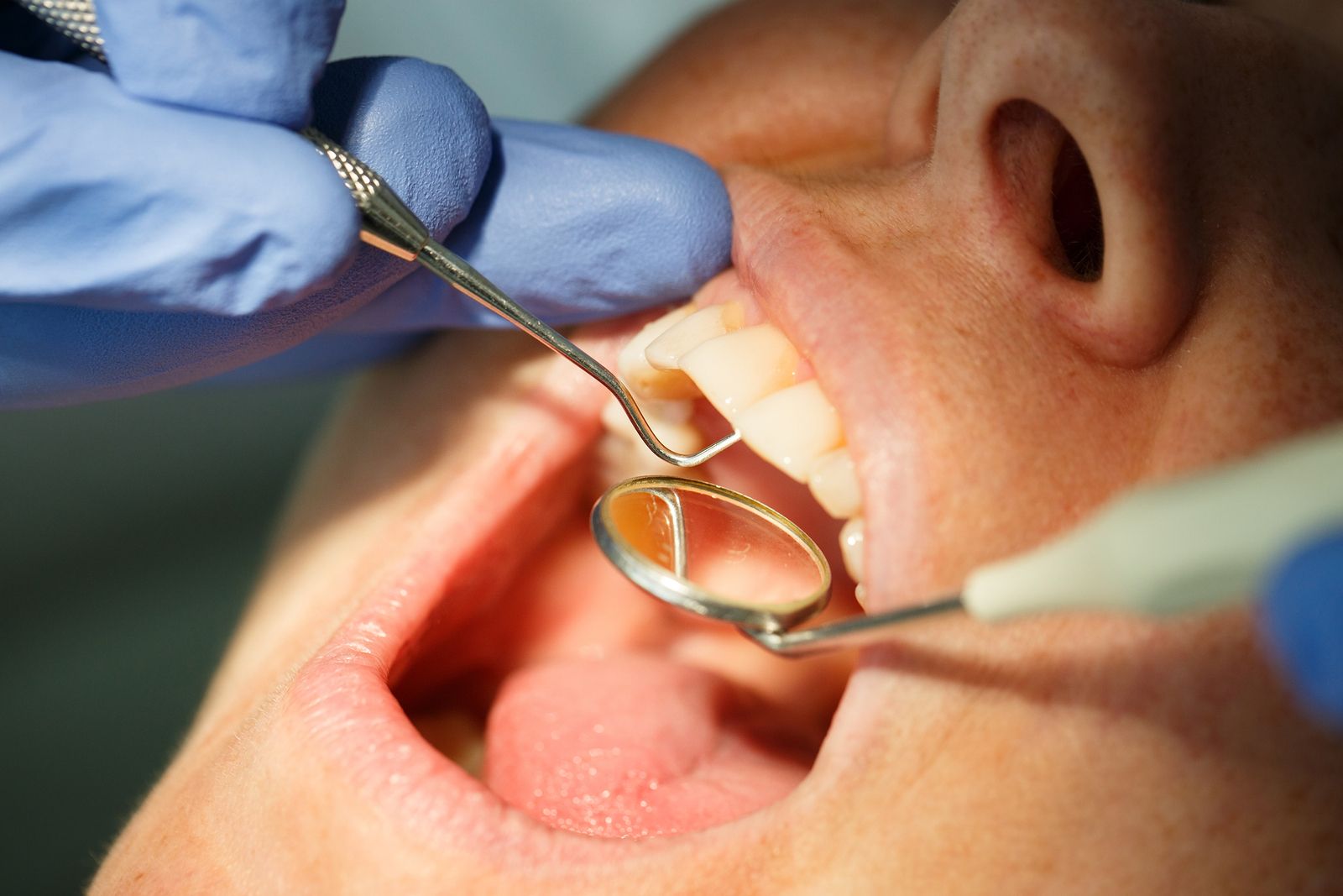 Paciente con caries siendo observado por el odontólogo