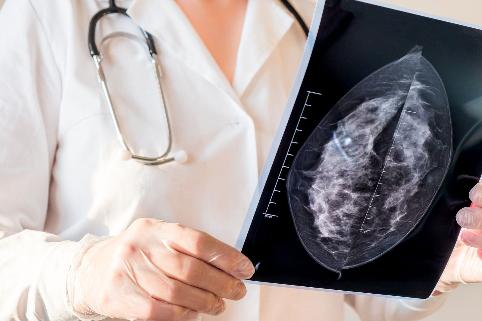 Un estudio demuestra que ampliar la edad de cribado del cáncer de mama reduce la mortalidad