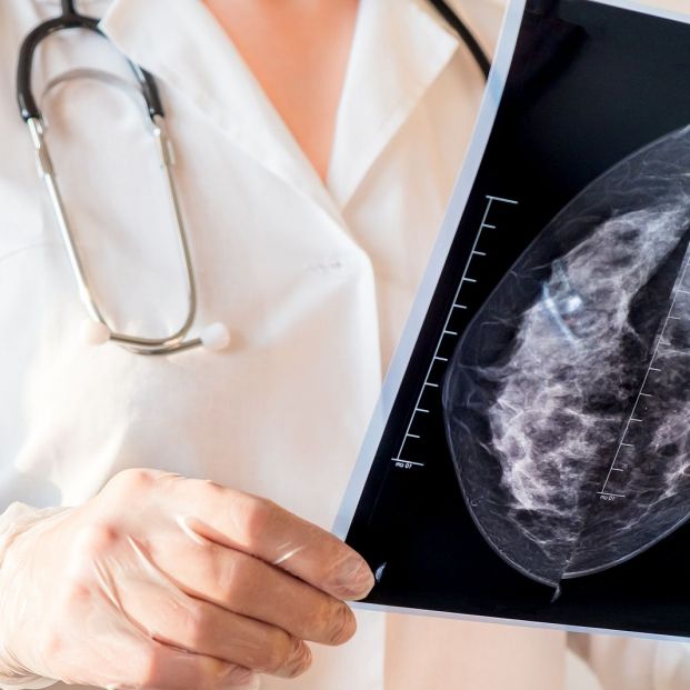 Radiólogos indican que el test de saliva no es un diagnóstico precoz para el cáncer de mama