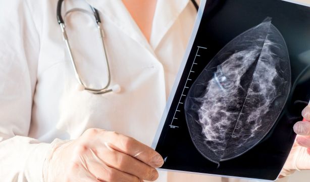 La radioterapia más corta mejora la calidad de vida de mujeres mayores con cáncer de mama 