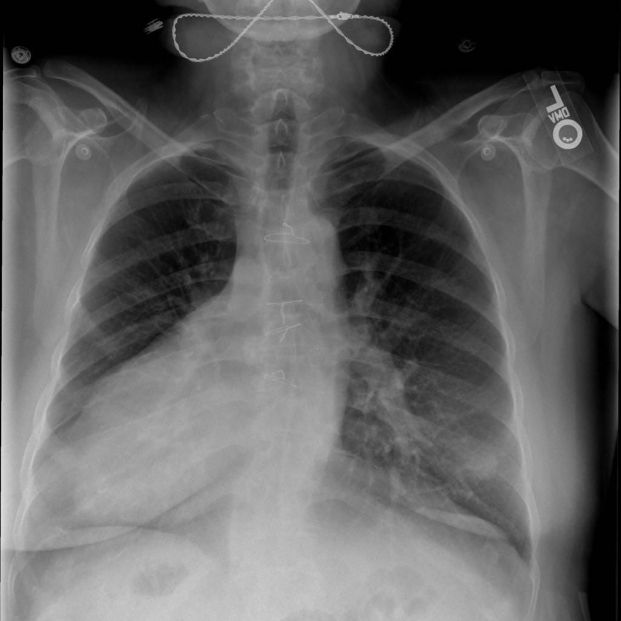 Radiografía de pecho y abdomen con situs inversus
