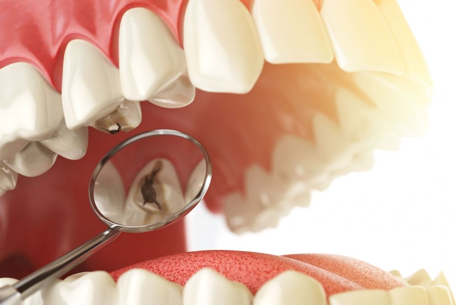 Los hallazgos en dientes de la Edad de Bronce revelan el impacto de la dieta en la salud dental (Bigstock)