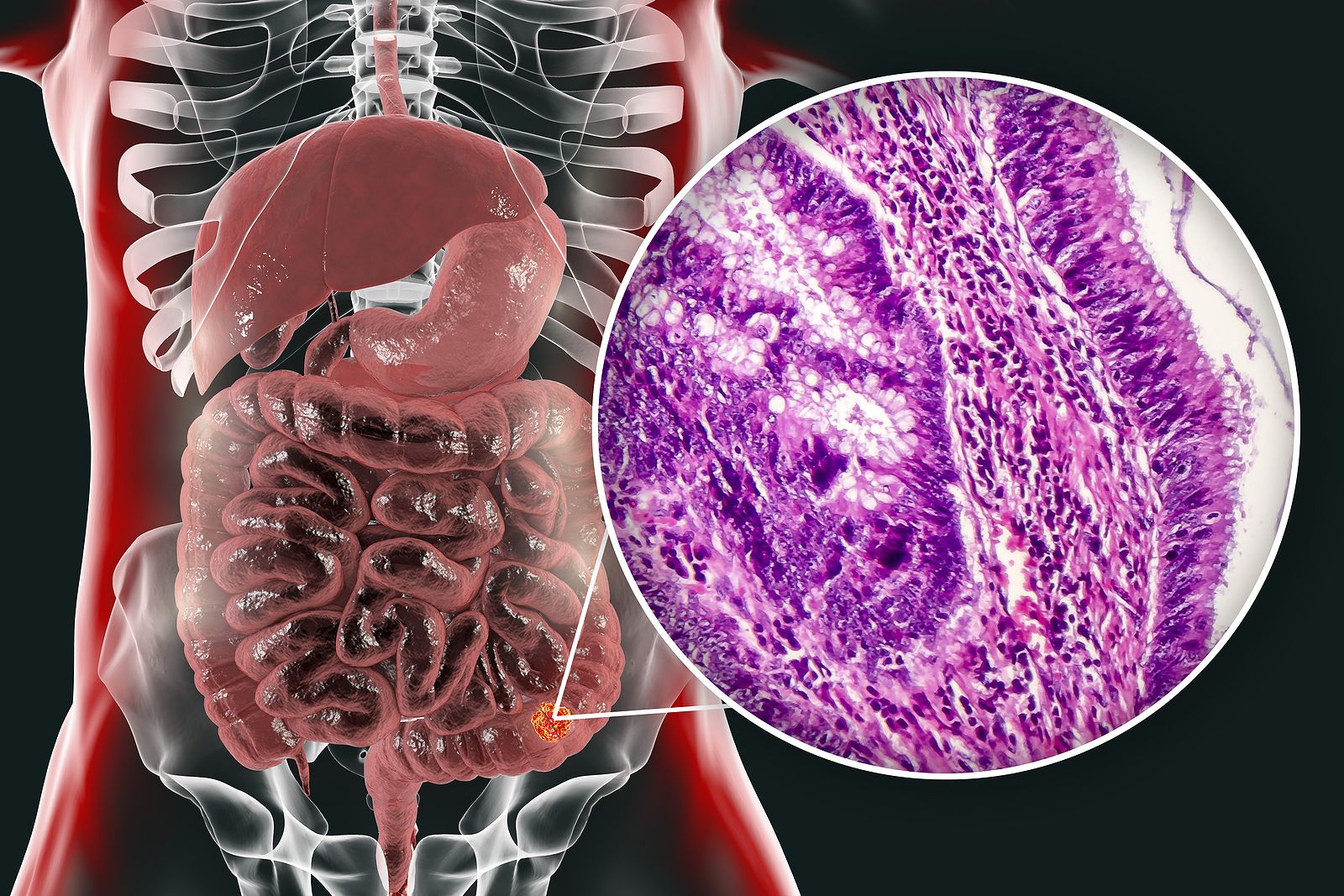 El cáncer de colon se cura en el 90% de los casos si se detecta en estadios iniciales