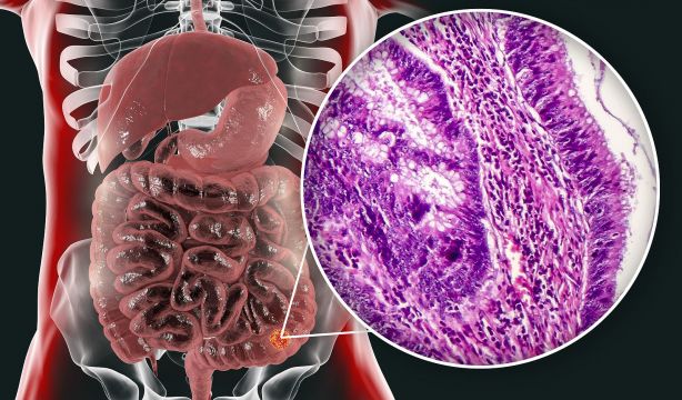El cáncer de colon se cura en el 90% de los casos si se detecta en estadios iniciales