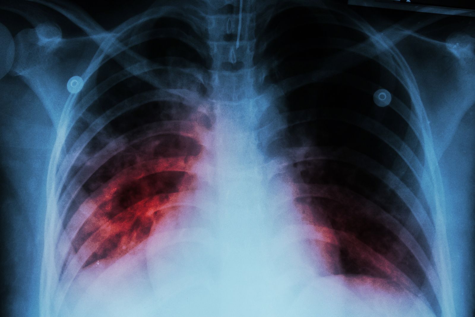 Las personas con tuberculosis tienen un 80%  más de probabilidades de padecer cáncer