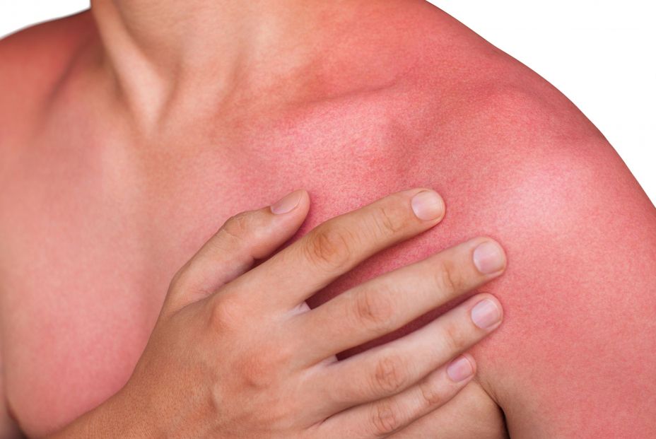Fotodermatitis: los casos de alergia al sol han aumentado significativamente en los últimos años (Bigstock)